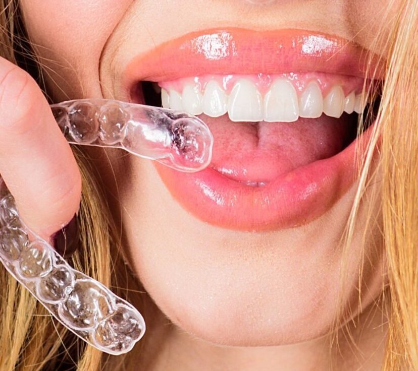 Clear aligner trays held beside a smile